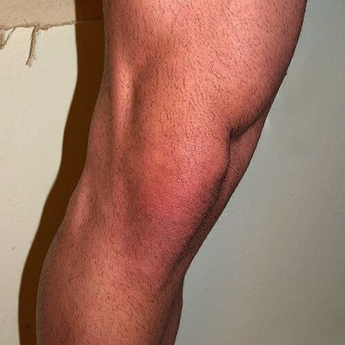 rodilla